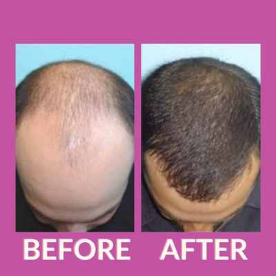 Hair Transplant in Great Nag Road, Nagpur