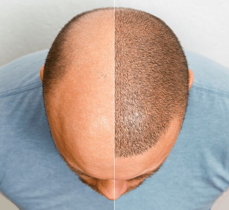 Hair Transplant Treatment