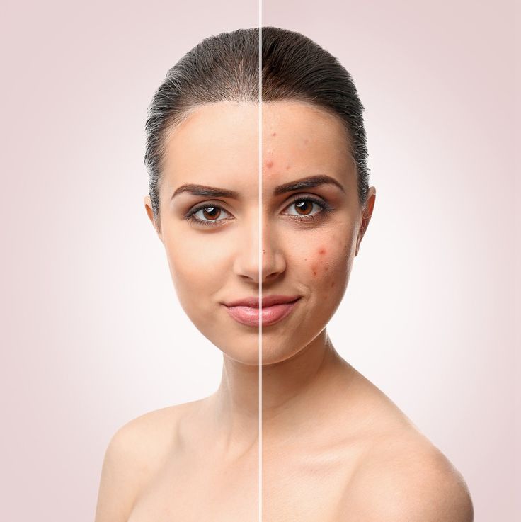 Rosacea & Acne Treatment